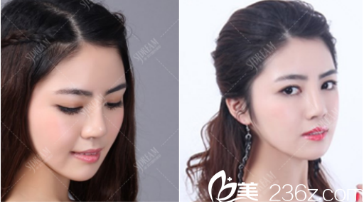 术后美丽的样子