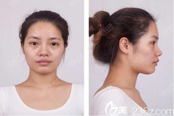 达州双均医院假体隆鼻项目术前照片