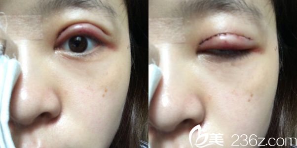 术后一天恢复情况 术后一天恢复情况