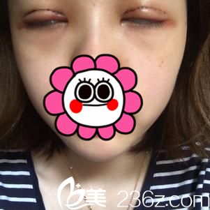 术后两天恢复情况 术后两天恢复情况