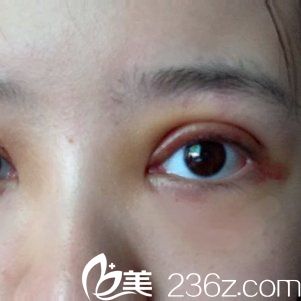 术后三天恢复情况 术后三天恢复情况