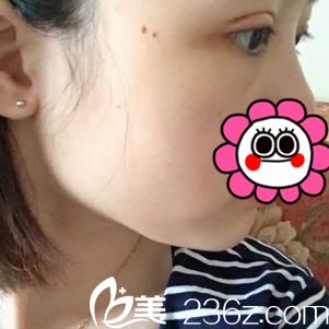 术后四天恢复情况 术后四天恢复情况