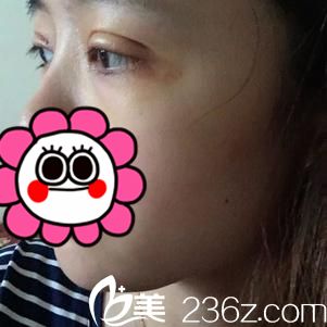 术后五天恢复情况 术后五天恢复情况