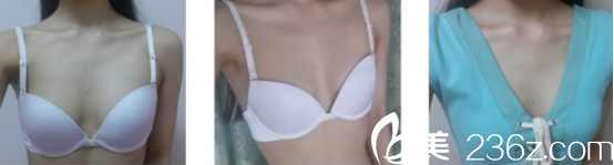 分享我在西安高一生做自体隆胸的日记 分享我在西安高一生做自体隆胸的日记