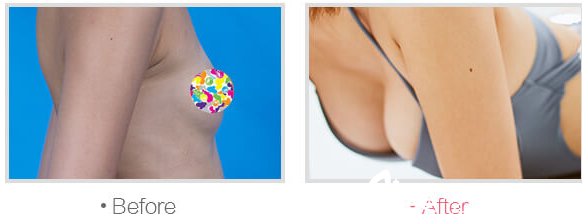 成都米兰柏羽APC全感丰胸案例 成都米兰柏羽APC全感丰胸案例