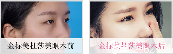 柏羽美杜莎美眼案例对比 柏羽美杜莎美眼案例对比