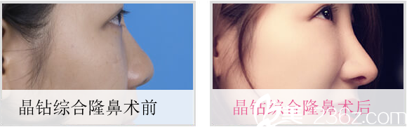 成都米兰柏羽晶钻综合隆鼻术后对比照 成都米兰柏羽晶钻综合隆鼻术后对比照