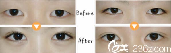 医院双眼皮案例