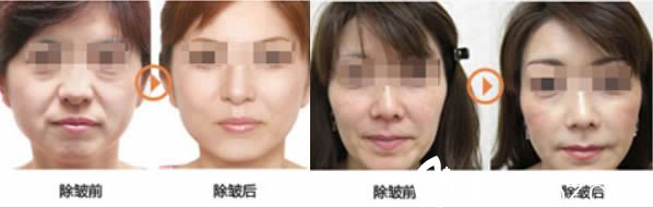龙岩新罗欧菲全面部除皱前后对比效果