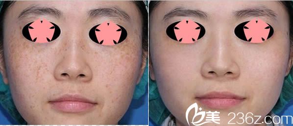 皮秒激光祛斑真实效果对比图