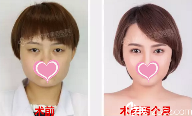 邱院长眼部整形真人案例前后对比