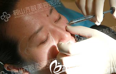 玻尿酸填充苹果肌