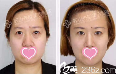 全面部玻尿酸填充前后对比