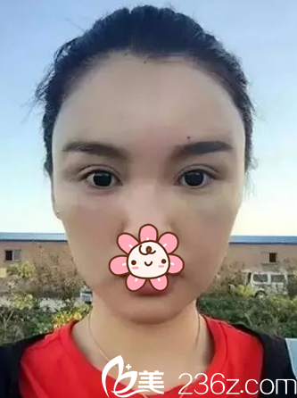 何山医生给我做完后第四天的样子 何山医生给我做完后第四天的样子