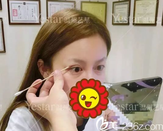 温州艺星双眼皮手术面诊过程