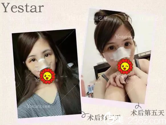 鼻综合整形手术第5天恢复照