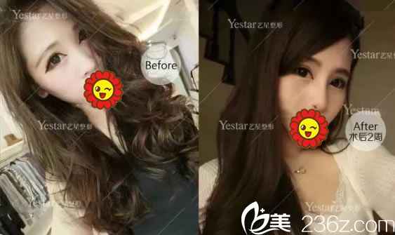 嘉兴艺星隆鼻手术2周效果对比图