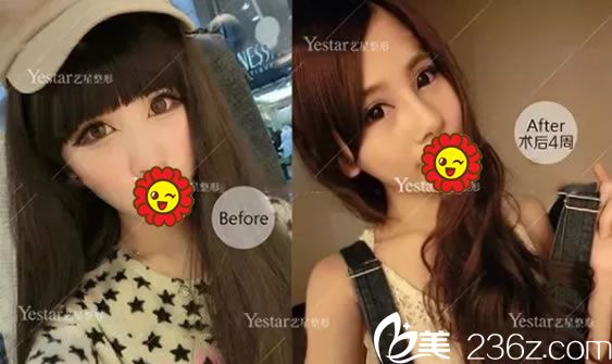 嘉兴艺星张占召假体隆鼻案例