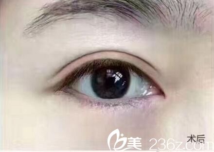 到许昌博爱打造大眼萌双眼皮 让我美的不止一点点