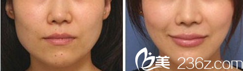 北京印正山医疗美容诊所案例 北京印正山医疗美容诊所案例