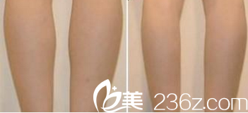 北京印正山郑泰成腿部吸脂案例