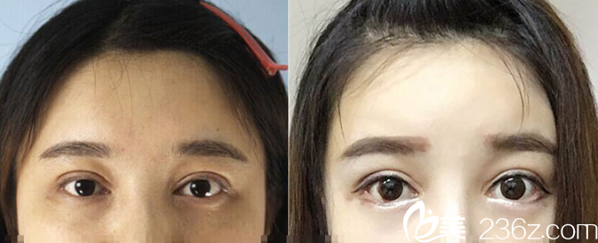 肇庆华美美容医院黄万宇下眼睑下至术案例