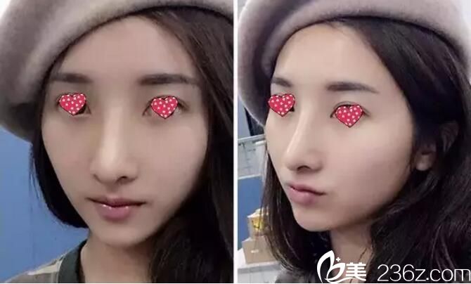 大而圆的鼻头外加低鼻梁在宿迁天黛做达拉斯综合隆鼻蜕变历程