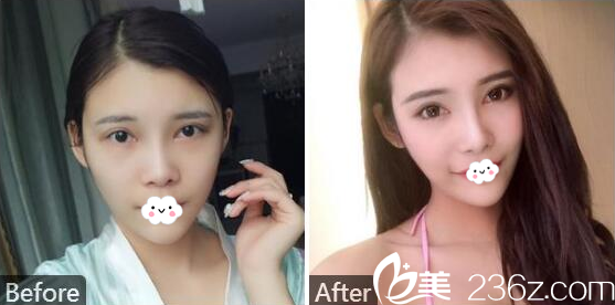 肇庆华美美容医院黄万宇双眼皮隆鼻案例