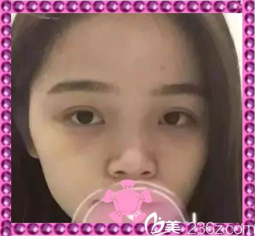 在<!--<i data=20240703-sp></i>-->整形医院做隆鼻术前照 在<!--<i data=20240703-sp></i>-->整形医院做隆鼻术前照