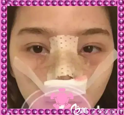 综合隆鼻术后第三天包着纱布的样子 综合隆鼻术后第三天包着纱布的样子