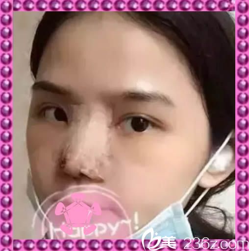 做完鼻综合整形术后第7天去医院取了鼻夹 做完鼻综合整形术后第7天去医院取了鼻夹