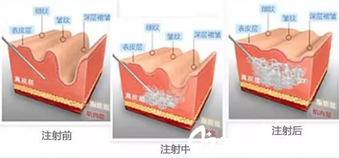 “玻尿酸和瘦脸除皱联合使用<span style=