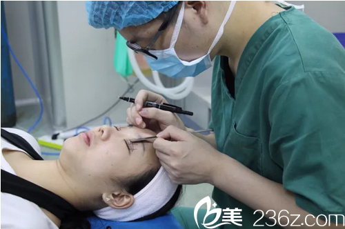 揭阳华美整形医院张旭双眼皮术前画线 揭阳华美整形医院张旭双眼皮术前画线