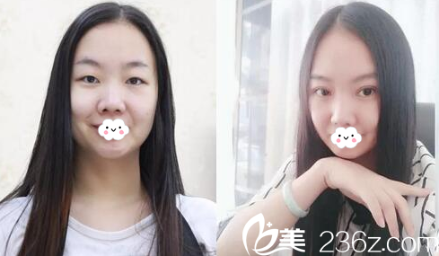 揭阳华美整形医院张旭医生做的双眼皮案例 揭阳华美整形医院张旭医生做的双眼皮案例