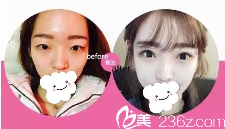 眼鼻综合术前术后对比案例 眼鼻综合术前术后对比案例