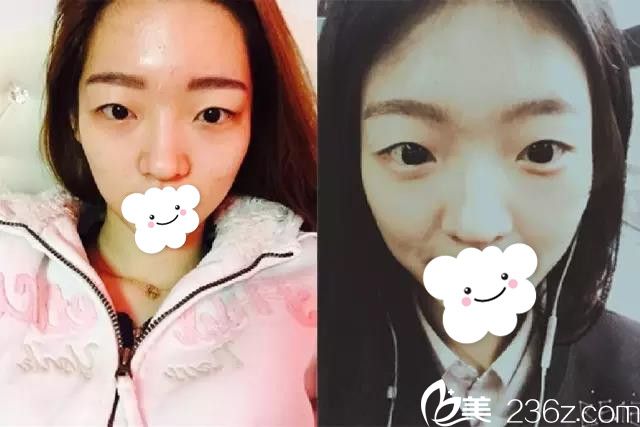 眼鼻综合术前样子 眼鼻综合术前样子