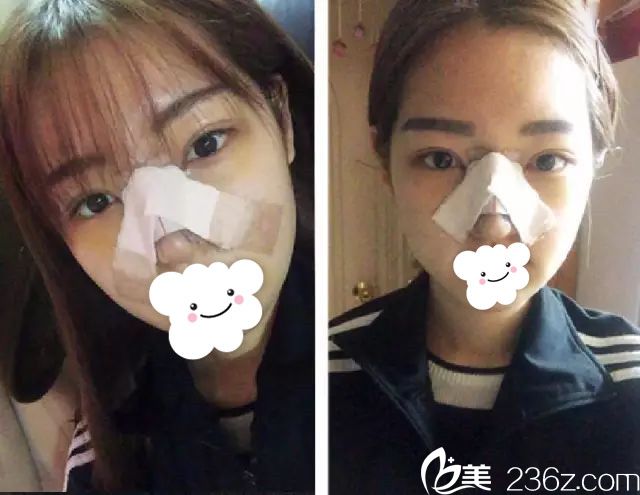 鼻综合加眼综合术后恢复中 鼻综合加眼综合术后恢复中