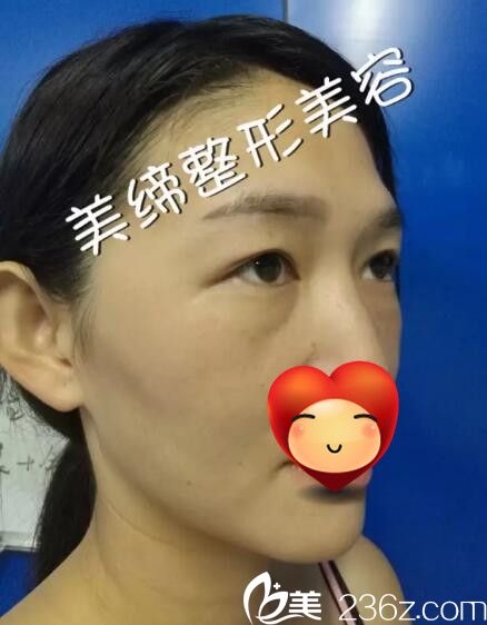 面部脂肪填充术前照片 面部脂肪填充术前照片