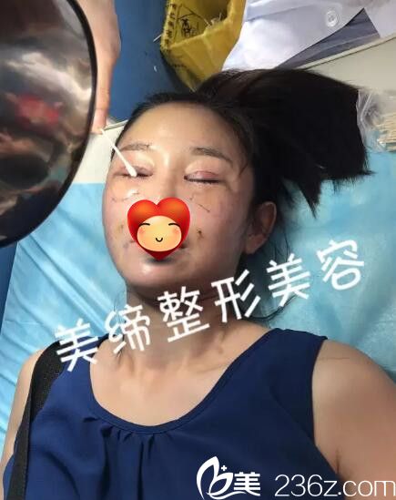 眼综合整形手术过程中 眼综合整形手术过程中