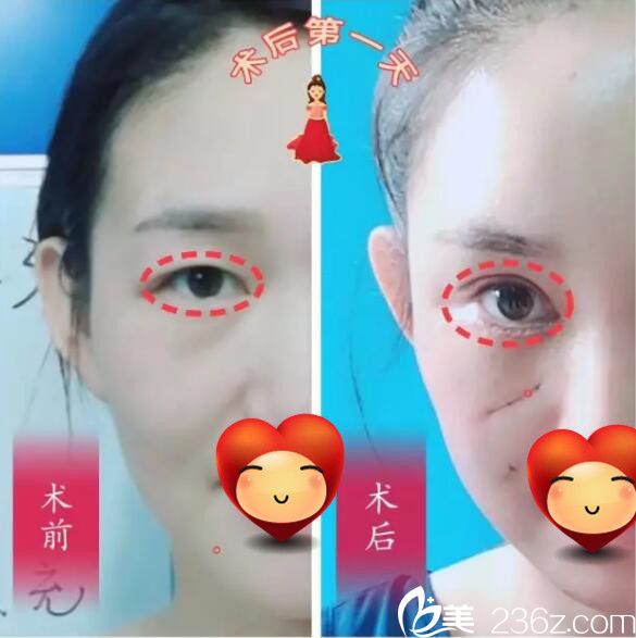 术后天整形恢复 术后天整形恢复