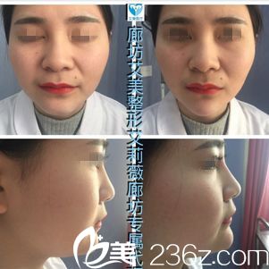 <!--<i data=20240703-sp></i>-->医生注射玻尿酸案例 <!--<i data=20240703-sp></i>-->医生注射玻尿酸案例