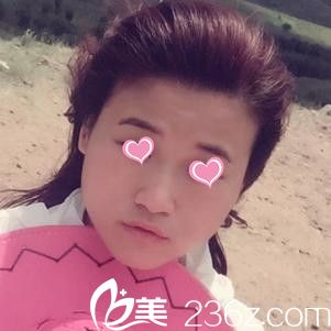 术前脸部肥大 术前脸部肥大