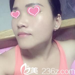 脸部刚注射完瘦脸除皱的样子 脸部刚注射完瘦脸除皱的样子