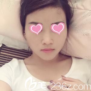 术后5天等待消肿 术后5天等待消肿