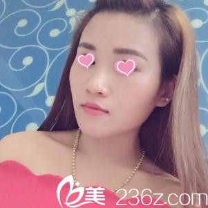 注射15天后脸型恢复情况 注射15天后脸型恢复情况