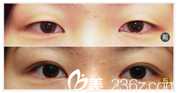 河源华美整形医院何为院长双眼皮案例 河源华美整形医院何为院长双眼皮案例