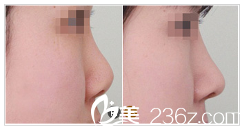 河源华美整形医院何为院长隆鼻案例 河源华美整形医院何为院长隆鼻案例