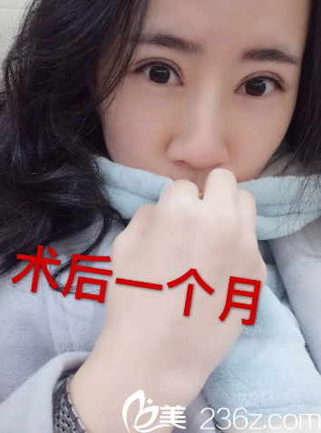 找河源华美整形医院何为院长做完全切双眼皮后整个人都变得自信了