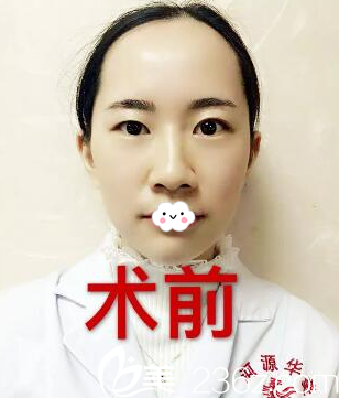 双眼皮术前照 双眼皮术前照