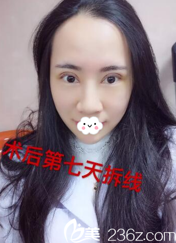 河源华美整形医院双眼皮7天拆线效果 河源华美整形医院双眼皮7天拆线效果